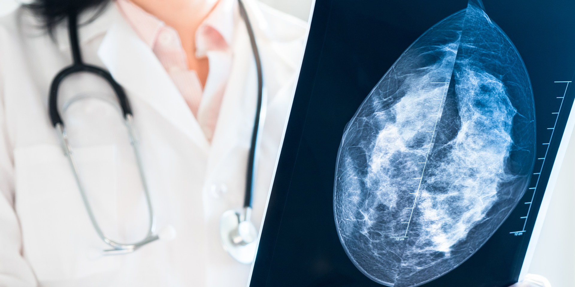 Benefits of 3D Mammography